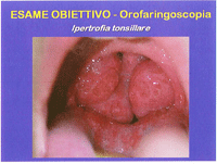 Notevole ipertrofia tonsillare, in fase acuta, di giovane ragazzo studente di canto