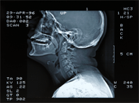 Fig. 13 TAC del vocal tract di cantante russatore. Evidente edema dell'ugola e del velo e caduta posteriore della base linguale (anche a riposo, anche di giorno)