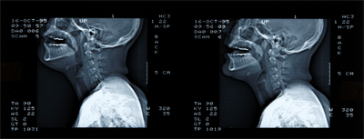 Fig.14 TAC del vocal tract nello stesso cantante.