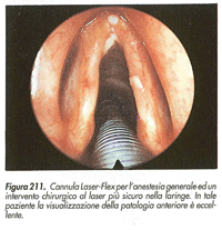 Fig. 15 Esempio di corretta scelta e posizione canulare