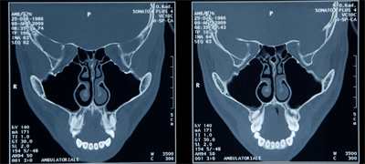 TAC mascellare: modica deviaz. Spina settale posteriore. E' l'ipertrofia dei turbinati a determinare la difficoltà del flusso respiratorio